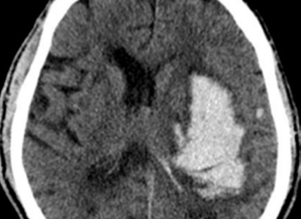 КТ при остром мозговом кровоизлиянии
