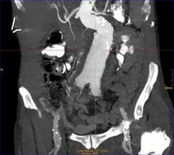 Aortic aneurysm