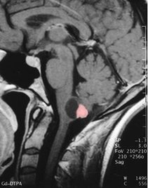Figure 1: Hemangioblastoma in the cerebellum