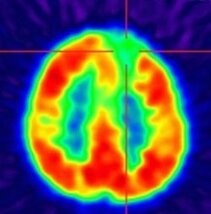 FDG-PET for hypometabolic area detection (here: focal-cortical dysplasia in the frontal part on the left side) (Department of Nuclear Medicine)