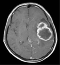 Glioma