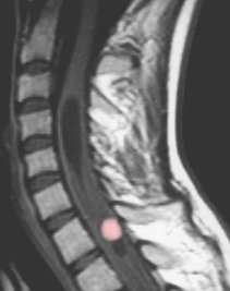 Figure 2: Hemangioblastoma of the spinal cord 