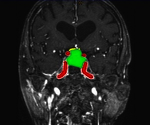 Magnetic resonance image of a typical pituitary macro adenoma