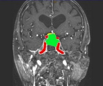 Magnetic resonance image of a typical pituitary macro adenoma