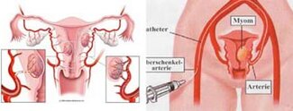 Эмболизация миомы матки 