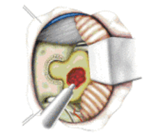 Figure 3: Removal of a tumor,vestibular schwannoma