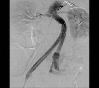 Abdominal aneurysm