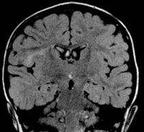 Detection of neuronal migration abnormality (cortical dysplasia) Department of Neuroradiology