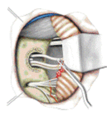 Figur1: Cerebellopontine angle 