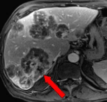 МРТ: метастазы в печени