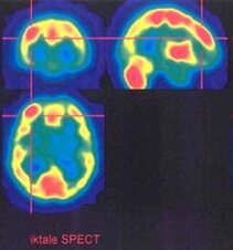 Ictal hyperperfusion in SPECT in case of cryptogenic frontal focal-cortical dysplasia (Department of Nuclear Medicine)