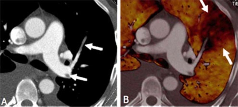 Blood clots in central pulmonary circulation (A). In contrast to the conventional method, Dual Energy CT can also visualize the pulmonary blood flow. In (B) a wedge-shaped blood-flow deficit is discernible behind the blood clot.
