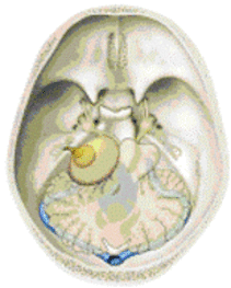 Figur 2: acoustic neurinoma 